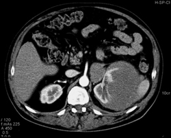 Renal Lymphoma - CTisus CT Scan