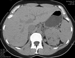 Angiomyolipoma (AML) With Minimal Fat - CTisus CT Scan