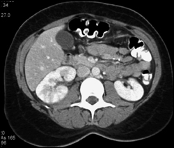 Acute Pyelonephritis - CTisus CT Scan