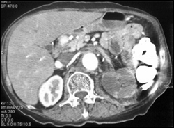 Renal Infarction - CTisus CT Scan