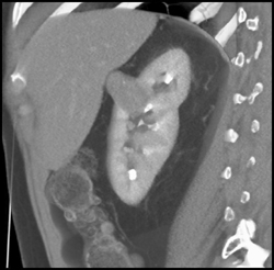 Renal Cell Carcinoma - CTisus CT Scan