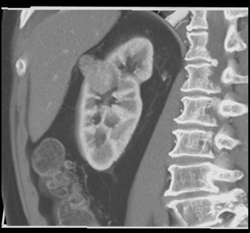 Renal Cell Carcinoma - CTisus CT Scan