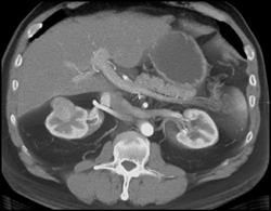 Renal Cell Carcinoma - CTisus CT Scan