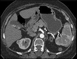 Renal Cell Carcinoma - Liver Lesion Is Metastatic Colon Cancer - CTisus CT Scan