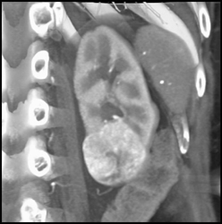 Renal Cell Carcinoma - CTisus CT Scan