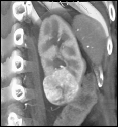 Renal Cell Carcinoma - CTisus CT Scan