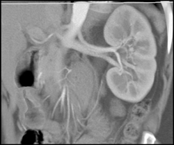 Normal Renal Artery and Vein - CTisus CT Scan