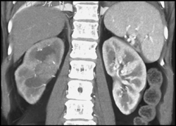 Transitional Cell Carcinoma of the Left Kidney - CTisus CT Scan