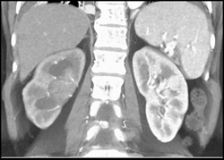 Transitional Cell Carcinoma of the Left Kidney - CTisus CT Scan