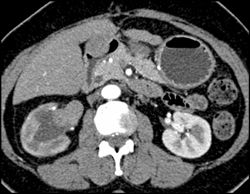 Transitional Cell Carcinoma of the Left Kidney - CTisus CT Scan