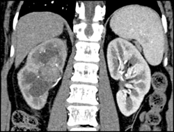 Transitional Cell Carcinoma of the Left Kidney - CTisus CT Scan