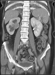 Transitional Cell Carcinoma of the Left Kidney - CTisus CT Scan