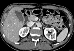 Circumaortic Renal Vein With Small Anterior Component - CTisus CT Scan