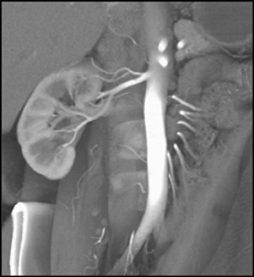 Retroaortic Renal Vein and Prehilar Branching of Both Renal Arteries - CTisus CT Scan