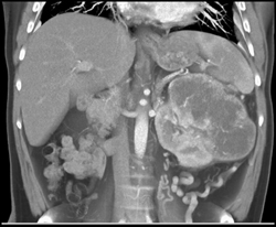 Renal Cell Carcinoma With Collaterals and Bone Metastases - CTisus CT Scan