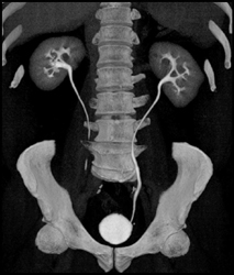 Normal CT Urogram - CTisus CT Scan