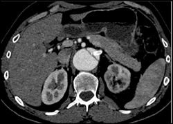 Decreased Left Renal Function With Stent in Place - CTisus CT Scan