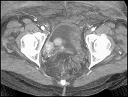 Bladder Cancer - CTisus CT Scan