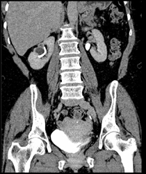 Recurrent Right Renal Cell Carcinoma - CTisus CT Scan