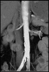 2 Right Renal Arteries With Stenosis in Upper Vessel - CTisus CT Scan