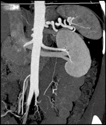 Normal Renal Artery and Venous Anatomy - CTisus CT Scan