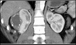 Subcapsular Hematoma in Page Kidney - CTisus CT Scan