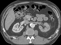 Decreased Function in Left Kidney Due to Dissection Involving the Left Renal Artery - CTisus CT Scan