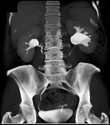 Bilateral Ureteropelvic Junction (UPJ) - CTisus CT Scan