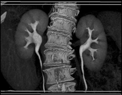 Normal CT Urogram - CTisus CT Scan