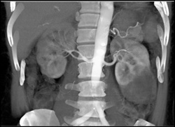 Renal Cell Carcinoma - CTisus CT Scan