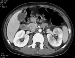 Acute Pyelonephritis - CTisus CT Scan