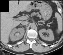 Clot in Right Renal Pelvis - CTisus CT Scan