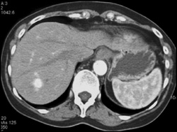 Renal Cell Carcinoma With Metastases to the Pancreas and Liver - CTisus CT Scan