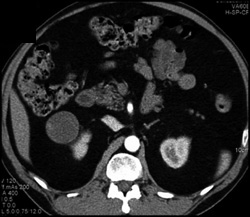 Cystic Renal Cell Carcinoma - CTisus CT Scan