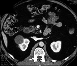 Cystic Renal Cell Carcinoma - CTisus CT Scan