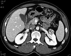 Renal Cell Carcinoma - CTisus CT Scan