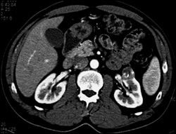 Renal Cell Carcinoma - CTisus CT Scan