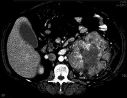 Renal Cell Carcinoma - CTisus CT Scan