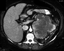 Renal Cell Carcinoma - CTisus CT Scan