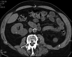 Renal Cell Carcinoma - CTisus CT Scan