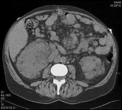 Bilateral Renal Angiomyolipomas - CTisus CT Scan