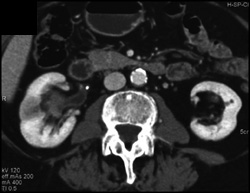 Transitional Cell Caricnoma of the Right Kidney - CTisus CT Scan