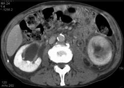 Transitional Cell Carcinoma of the Left Ureter and Pelvis - CTisus CT Scan