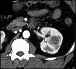 Renal Cell Carcinoma - CTisus CT Scan