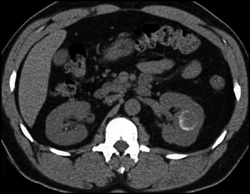 Renal Cell Carcinoma - CTisus CT Scan