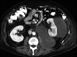 Perirenal and Pararenal Space Hematomas - CTisus CT Scan