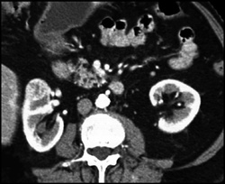 Renal Cell Carcinoma - CTisus CT Scan