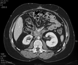 Retroperitoneal Fibrosis - CTisus CT Scan