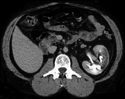 Renal Infarction - CTisus CT Scan