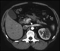 Renal Infarction - CTisus CT Scan